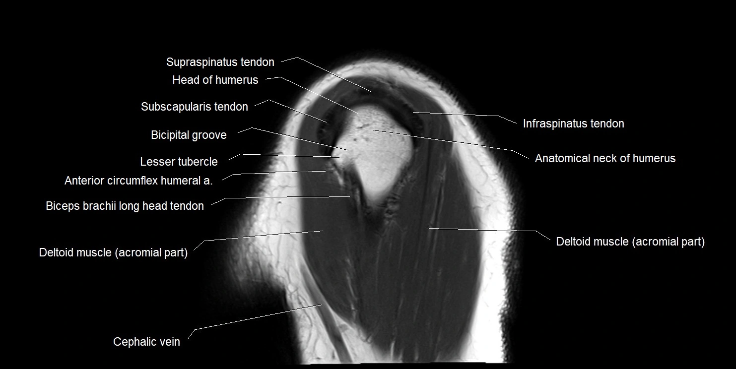 mri shoulder sagittal cross sectional anatomy image 16.webp